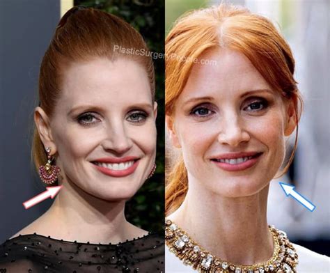 jessica chastain plastic surgery|Jessica Chastain on Getting Plastic Surgery: Who。